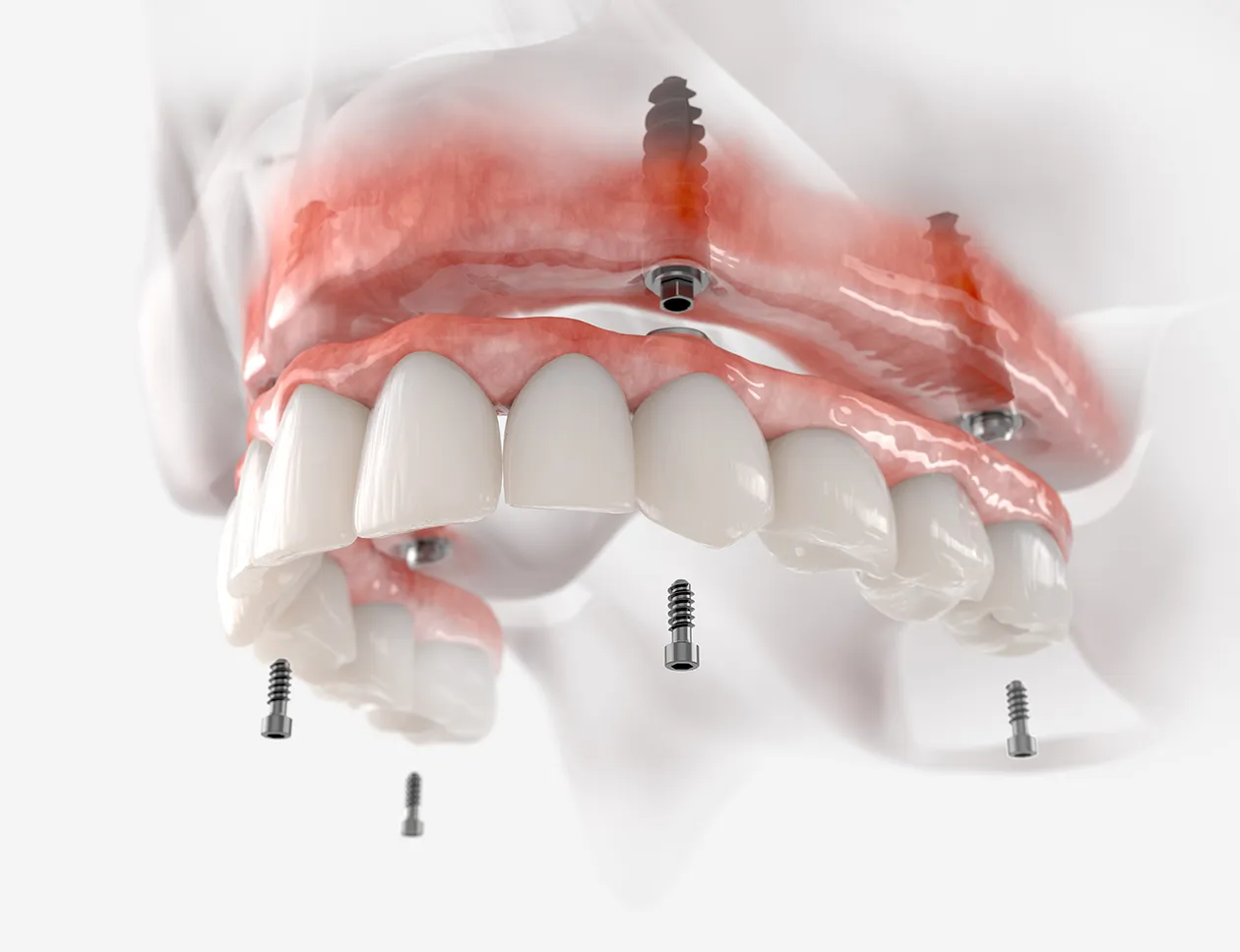 Positioning of four implants in the jaw for All-on-4 treatment