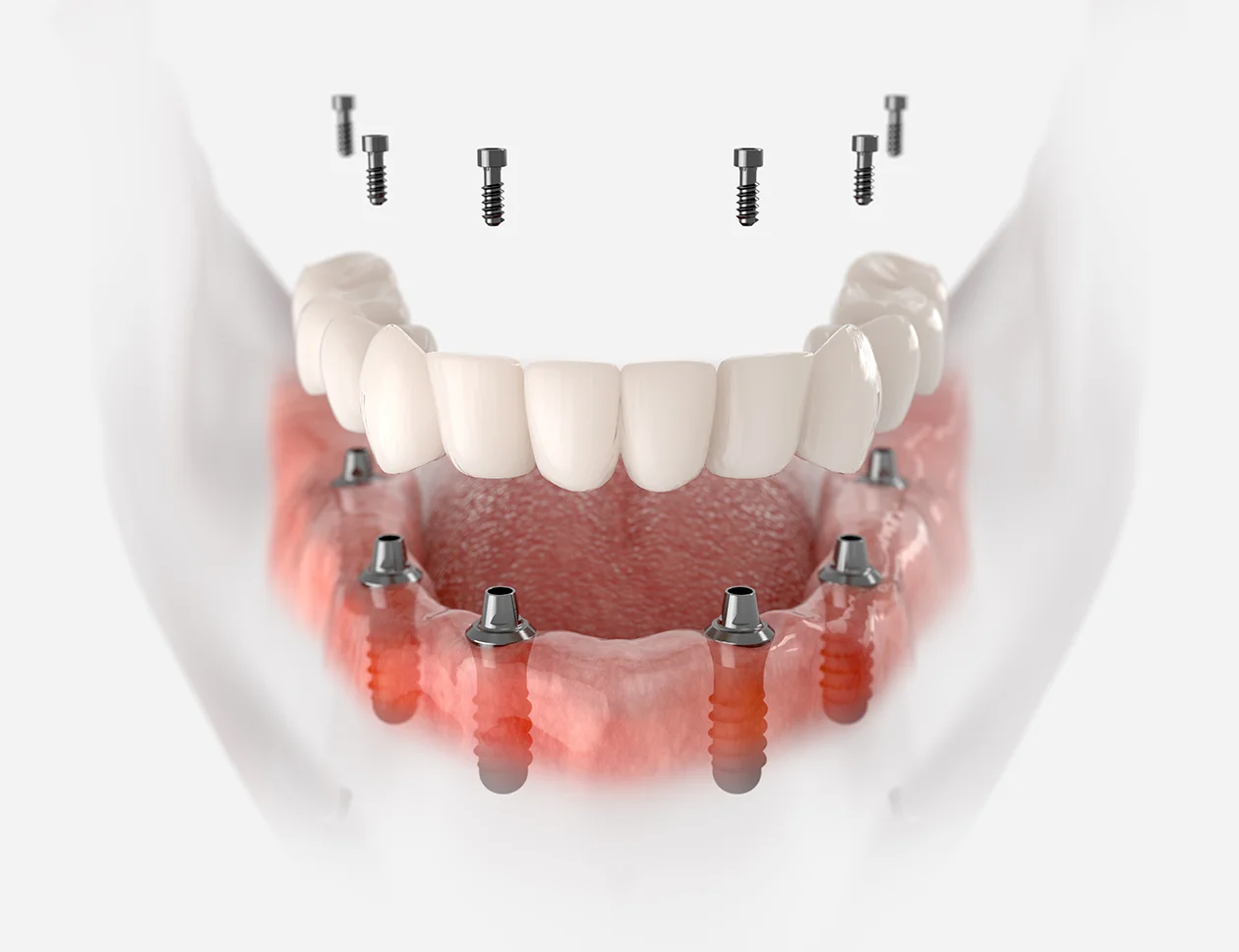 Positioning of six implants in the jaw for All-on-6 treatment